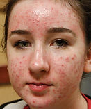 bbl_Hero_Cape_Town_Acne_Treatment