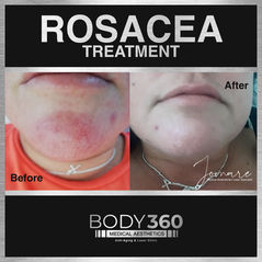 rosacea treatment treatment cape town doctor aesthetics clinic.jpg