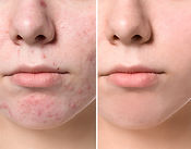face acne treatment teen roaccutane doctor near me
