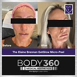 The Elaine Brennan GetGlow Micro-Peel Cape Town before and After
