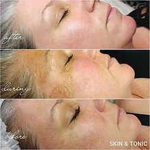 The Elaine Brennan Skin Renewal Peeling System body 360 medical aesthetics cape town.jpg